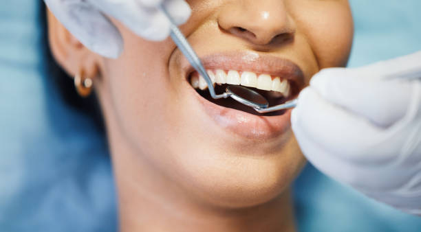 Best Knocked-Out Tooth (Avulsed Tooth) Treatment in Pratt, KS
